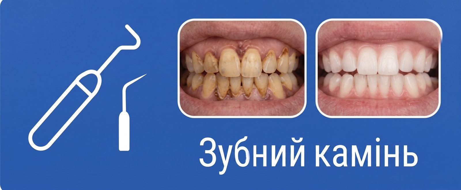 Зубний камінь